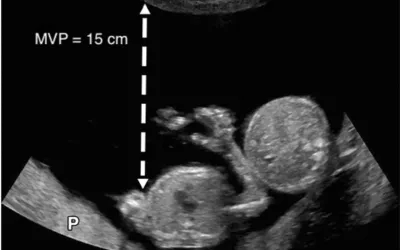 Twins on fetal ultrasound. Visible are the two heads and one of them has their arm outstretched. Image courtesy of RSNA. Twin baby ultrasound. 