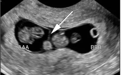 Twins on fetal ultrasound. The arrow points to the line showing the separate of the amniotic sacs. Image courtesy of RSNA. Twins baby ultrasound.