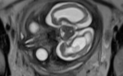 MRI of a fetus infected with zika virus microcephaly, which causes a smaller head circumference measurement than what is normal. Image from a zika patient in Brazil, which was at the epicenter of the mosquito-borne zika virus outbreak. Image courtesy of RSNA