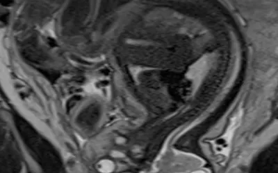 MRI of a fetus infected with zika virus microcephaly, which causes a smaller head circumference measurement than what is normal. Image from a zika patient in Brazil, which was the epicenter of the mosquito-borne zika virus outbreak. Image courtesy of RSNA. Baby with Zika Virus on MRI. 