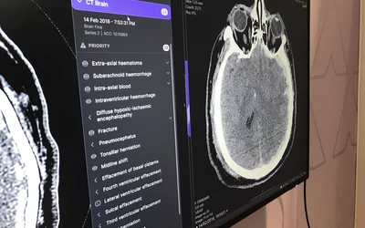 Example of data generated by an automated artificial intelligence (AI) brain CT assessment tool from Annalise.ai at RSNA 2022. What does brain imaging look like?