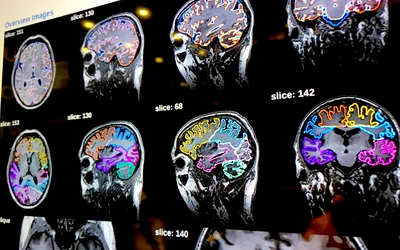 Assessment of brain atrophy on MRI using the automated Quantib artificial intelligence algorithm, where AI automates quantification faster and more accurately than a human can. Cerebral atrophy is from the loss of neurons and the connections between them. Many diseases can cause atrophy, including Alzheimer's disease, cerebral palsy, Pick's disease, Huntington's disease, multiple sclerosis, epilepsy and others. This example was displayed at RSNA 2022. What does brain atrophy look like on medical imaging? 