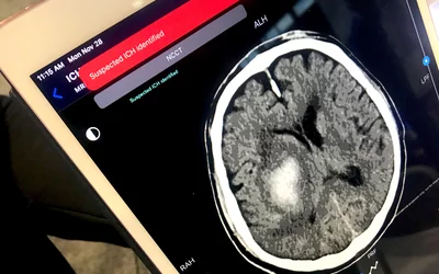 Example of an artificial intelligence (AI) automated notification on an iPad alerting a stroke alert team that a intracranial hemorrhage (ICH) stroke has been detected. These alerts can help speed review by a radiologist and treatment for the patient. This was demonstrated using Terarecon's system at RSNA 2022. What does a brain hemorrhage, bleeding stroke, look like on medical imaging?