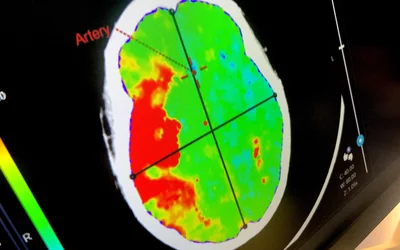AI detected intracranial hemorrhage (ICH) stroke demonstrated using Terarecon's system at RSNA 2022. What does a brain hemorrhage, bleeding stroke, look like on medical imaging?