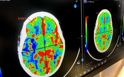 AI detected intracranial hemorrhage (ICH) stroke demonstrated using TR Neuro AI Solution from Terarecon at RSNA 2022.