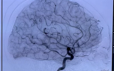 Example of a brain angiogram showing an catheter iodine contrast injection in a carotid artery to enhance the blood flow carrying the contrast throughout the brain to assess perfusion. This is performed in neuro interventional cath lab procedures to determine the location of blockages in the arteries so a thrombectomy procedure can be done to remove the clot and restore blood flow in ischemic strokes. Image courtesy of Shimadzu.