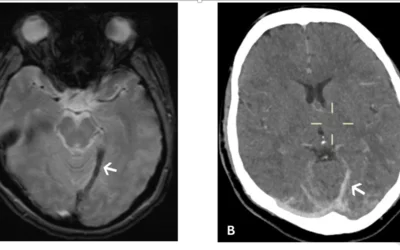 Example of a rare blood clot in the brain caused by the COVID-19 vaccine, which has caused a stroke. Images courtesy of RSNA.