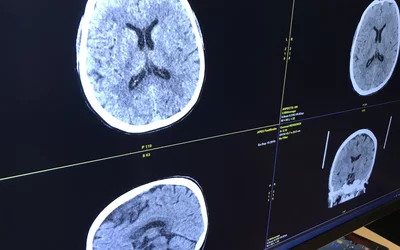 Example of an ischemic stroke on a head CT scan. Iodine contrast is injected into the patient to show areas of low perfusion, which can be seen in the less bright area of the brain at the top of the skull. Image from a GE Healthcare Revolution CT scanner.  What does stroke look like on CT?