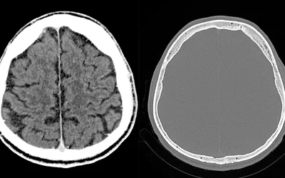 A comparison of contrast and noncontrast brain computed tomography (CT) scans from the same patient.The iodine contrast have help show details in soft tissues and organs that otherwise cannot be seen on non-contrast scans.