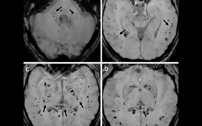 COVID-19 caused brain hemorrhage on MRI. The SARS-CoV-2 virus commonly causes clotting in patients that can result in strokes, but it also can cause brain hemorrhages in less common cases. Images courtesy of RSNA.