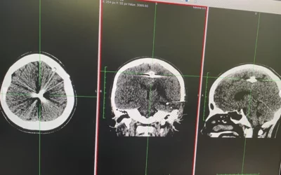 Brain CT scan showing shrapnel from Russian rocket artillery in between the hemispheres of the brain after entering the front temple of a 13-year-old female civilian from the Mykolaiv region Ukraine when her village was bombarded during the Russian invasion in March 2022. She was taken to Ohmatdyt children's hospital in Kyiv to remove the fragment, which was performed with ultrasound guidance.