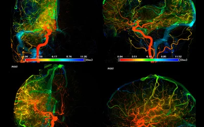 Parametric imaging of an ischemic stroke pre- and post-thrombectomy to remove the clot. Canon angiography image.