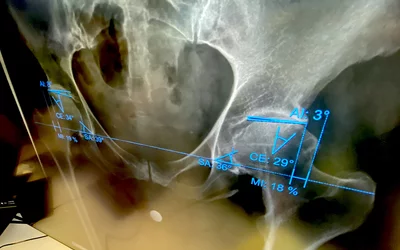 AI automated measurements for hip dysplasia, Sectra HIMSS23.