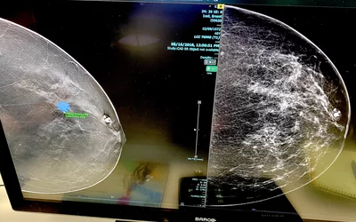 AI detection of breast cancer on the Fujifilm PACS at HIMSS 2023. Photo by Dave Fornell