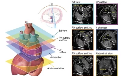 Axial planes suggested for screening the fetal heart at the time of the obstetric anatomic survey and as an initial series obtained during fetal echocardiography. #Fetalecho