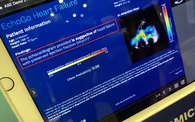 An AI generated report to detect heart failure patients with preserved ejection fraction (HFpEF) by looking at a single apical four-chamber view during a cardiac ultrasound exam. HFpEF can be difficult to detect on echocardiography, and this is the first AI cleared to detect it, filling an unmet need. The Ultromics EchoGo technology received the FDA's breakthrough device designation and was then cleared by the FDA at the end of 2022. Photo by Dave Fornell at the American Society of Echo (ASE) 2023 meeting.