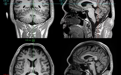 MRI image quality and soft tissue resolution increases the more powerful a magnet is. Standard MRI systems are 1.5 Tesla (T), but 3T systems are becoming more common and a 7T system is also available. This image is from a Canon Vantage Titan 3T system with MP-RAGE (magnetization prepared - RApid gradient echo) enhanced T1 gray-white matter contrast for surgical planning. Canon RSNA PR image