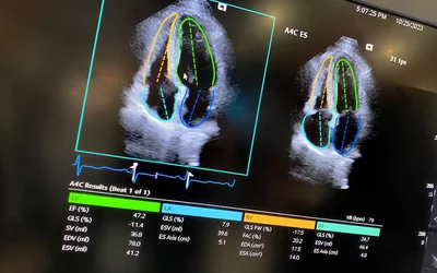 Example of automated AI cardiac ultrasound measurements on the Siemens Acuson Origin cardiac ultrasound system, cleared by the FDA in October 2023. The AI has automatic view recognition and anatomical contouring to pick the best view and position to make more than 5,000 types of measurements and automate strain and ejection fraction assessments. 