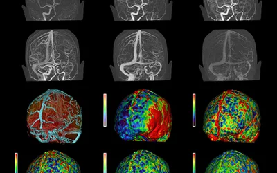Series of CT iodine contrast enhanced images showing an ischemic stroke. The vessels on both halves of the brain should be symmetrical, but the top vascular images show filling defects on the right side, indicating an obstruction. The bottom images show CT brain perfusion, showing a a lack of blood flow, best seen in red in the center image. Imaged on a Canon Aquilion One. Canon RSNA PR image