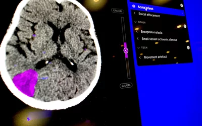 AI detected Acute brain infarct ischemic stroke, shown by Annalise at RSNA 2023. Photo by Dave Fornell. #RSNA #RSNA23 #RSNA2023