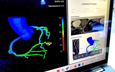 AI FFR-CT from a cardiac CT scan demonstrated by Keya Medical at SCCT 2023.