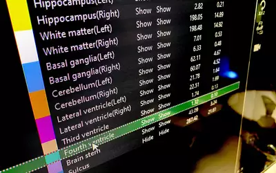 Brain MRI automated AI assessment with measurements on Fujifilm's Synapse system at RSNA 2023. Photo by Dave Fornell. #RSNA #RSNA23 #RSNA2023 orthopedic imaging