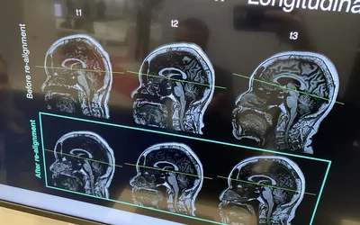 AI reformatting of misaligned patients in the MRI scanner fixed by Subtle Medical's SubtleALLY demonstrated at RSNA 2023. This slight change in formatting may be important for patients undergoing serial exams used in cancer treatments or disease monitoring. The AI was cleared in May 2023. Photo by Dave Fornell. 