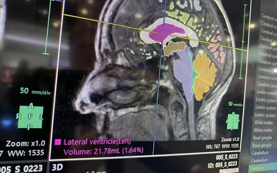 Brain MRI AI assessment and segmentation on Fujifilm's Synapse system at RSNA 2023. Photo by Dave Fornell. #RSNA #RSNA23 #RSNA2023