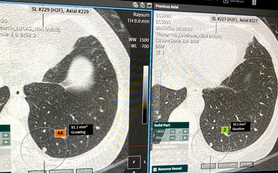 Lung CT low-dose lung screening using AI lung nodule detection, shown by CoreLine at SCCT 2023. Photo by Dave Fornell