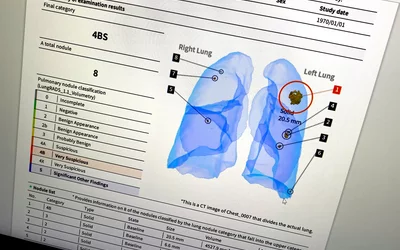 Lung CT low-dose lung screening using AI lung nodule detection, shown by CoreLine at SCCT 2023. Photo by Dave Fornell