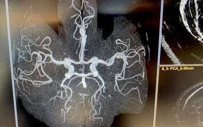 MRI showing blood vessels in the brain enhanced with gadolinium contrast. This type of imaging can show stroke, vascular malformations, aneurisms, cerebral hemorrhages and highlight tumors with vascular networks. Imaged on a Philips Blue Seal 1.5T system. Brain MRI images of a Philips Blue Seal 1.5T system. #RSNA #RSNA23 #RSNA2024