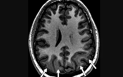 Example of epilepsy MRI in a 21-year-old man with a cortical migrational abnormality. This axial, T1-weighted magnetization-prepared rapid acquisition GRE image shows symmetric band (arrows) of abnormal heterotopic subcortical gray matter signal intensity. Image courtesy of the American Journal of Roentgenology (AJR)