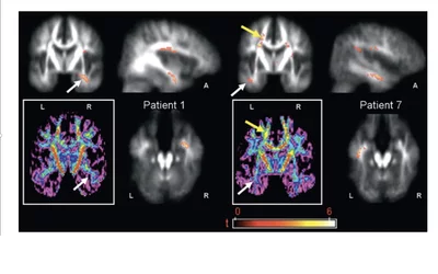 Epilepsy seen in MRI post-processing to show the epileptogenic zone (EZ) location. Focal epilepsy is a common and severe neurologic disorder and neuroimaging aims to identify the EZ. For about a third of patients with chronic drug-resistant focal epilepsy, the EZ cannot be precisely identified using standard 3.0-T MRI. Computational image processing can aid radiologic assessments and increase the success rate of uncovering suspicious regions by enhancing their visual conspicuity. Image courtesy off RSNA.