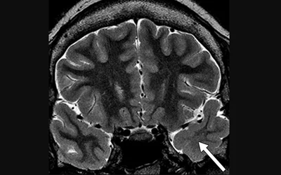 Temporal lobe epilepsy, hippocampal sclerosis, and white matter abnormalities in anterior temporal lobe of a 21-year-old woman with temporal lobe epilepsy and anterior temporal lobe epilepsy and anterior temporal lobe white matter abnormalities. Coronal T2-weighted images show blurring at gray-white matter junction and white matter volume loss and increased signal intensity (arrow, C) in anterior left temporal lobe. Image courtesy of the American Journal of Roentgenology (AJR)