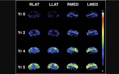 Example of Parkinson's disease progression in different portions of the brain over the course of time using serial 18F-FDG PET nuclear imaging scans. The images shows progressive metabolic reduction from the baseline (Year 0), through stages of mild cognitive impairment (Years 2 and 4), and clinical diagnosis of dementia (Year 5). Progressive metabolic reductions in cuneus and precuneus occur before less severe, but more widespread, cortical reductions. Image from SNMMI
