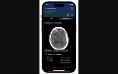 Viz.ai ICH Plus gains FDA approval. The AI obtains accurate and quantifiable measurements of intracerebral hemorrhages through Viz ICH Plus significantly enhances our decision-making process.