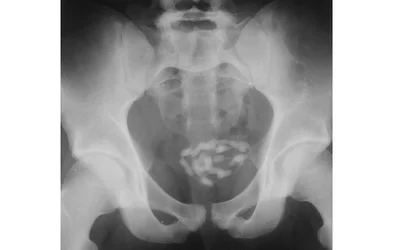 Radiograph of an 18-year-old man demonstrates bladder calculi that had formed on fine telephone wire. Six months before, he lost the wire in his bladder when he achieved an erection while inserting the wire into his urethra during masturbation. Image courtesy of George Barnes, MD and RSNA.