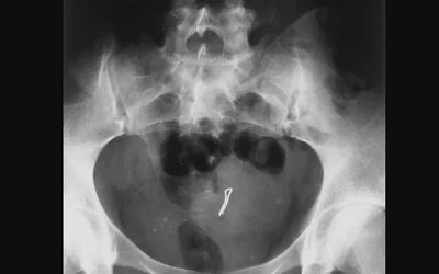 A 19-year-old woman with a bobby pin lodged in her uterus from an attempted abortion. Image courtesy of RSNA