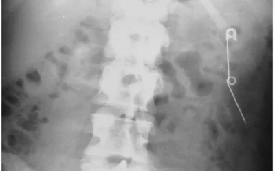 A 28-year-old woman who periodically swallowed pins and razor blades shows an open safety pin in her descending colon onm X-ray. The pin passed without difficulty. Courtesy of RSNA.