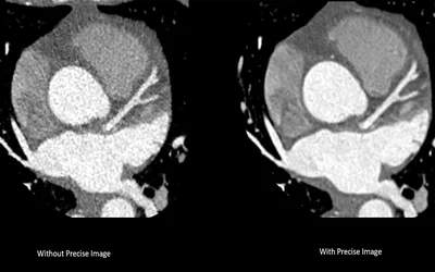 A comparison showing quality improvement using the new Precise Image AI image reconstruction software on the new Philips Healthcare CT 5300 system.