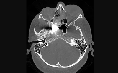 Head CT of a soldier with a bullet lodged in their sphenoid sinus at a hospital in Dnipro. Photo by radiologist Olga Kachanova. Courtesy of RSNA.