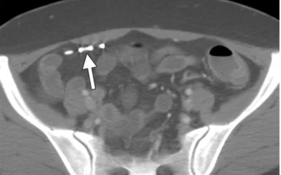 An intrauterine device (IUD) migration seen on an axial CT scan (arrow). The device is more apparent and easier to identify using the CT scout scan. Courtesy of RSNA https://pubs.rsna.org/doi/full/10.1148/rg.312105123