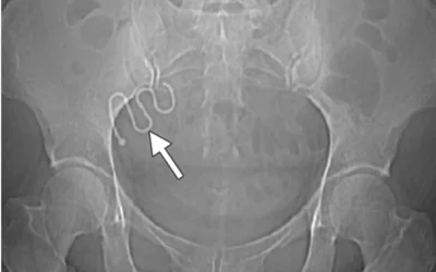 An intrauterine device (IUD) migration on a CT topogram helps identify the object (arrow) as a migrated IUD. Courtesy of RSNA https://pubs.rsna.org/doi/full/10.1148/rg.312105123