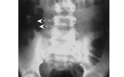 Radiograph shows a pencil (arrows) lodged in the ascending colon. It passed without difficulty, which is unusual for such an elongated object to pass through the intestinal tract without problems. Courtesy of RSNA https://pubs.rsna.org/doi/10.1148/rg.233025137