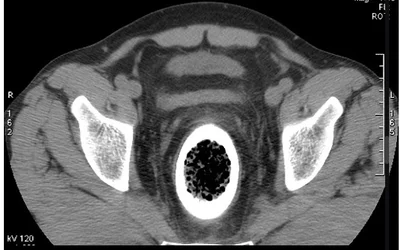 Appearance of a glass Coca Cola bottle within the rectum and distal sigmoid colon on an axial CT scan. Case courtesy of Essam G. Ghonaim, https://radiopaedia.org/cases/rectal-foreign-body-6?lang=us