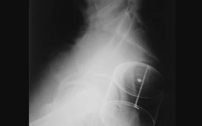 Radiograph of a 60-year-old man demonstrates a condensed milk can that he had inserted into his rectum. Courtesy of George Barnes, MD and RSNA.