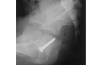 Radiograph of a young child shows a screw that she had inserted into her vagina. Courtesy of RSNA.