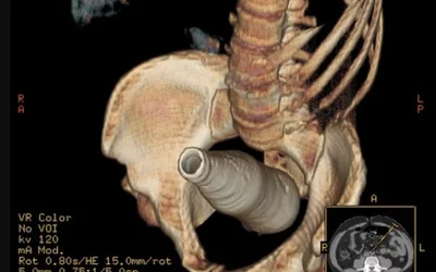 CT 3D reconstruction images of a Coca cola bottle within the rectum and distal sigmoid colon. Bottle was used as a butt plug during Masturbation. Case courtesy of Essam G. Ghonaim, https://radiopaedia.org/cases/rectal-foreign-body-6?lang=us