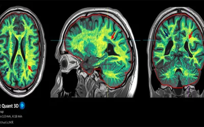 Example of Philips Smart Quant Neuro 3D quantitative tissue assessment software. It reconstructs the MRI image to provide automatic and precise 3D segmentation and volume measurement of brain tExample of Philips Smart Quant Neuro 3D quantitative tissue assessment software. It reconstructs the MRI image to provide automatic and precise 3D segmentation and volume measurement of brain tissue, a breakdown of white matter, gray matter, cerebrospinal fluid, and myelin to make a better diagnosis. 