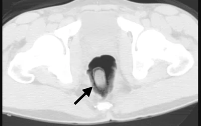 Smuggled narcotics packet on Contrast-enhanced CT scan. Courtesy of RSNA